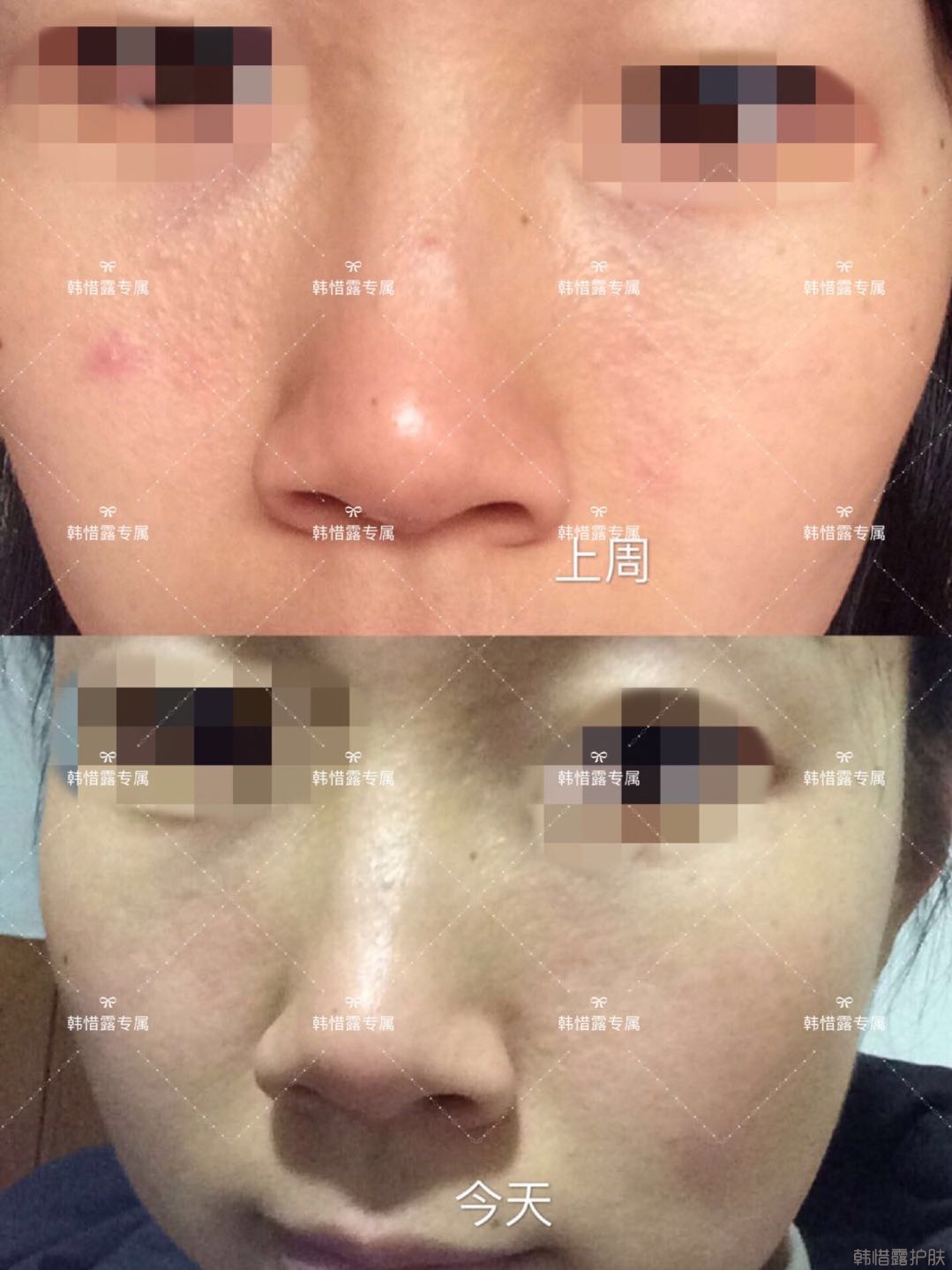 粉刺痘痘怎么有效去除？以前不敢拍燈光下照片，粉刺少了，現(xiàn)在敢了！