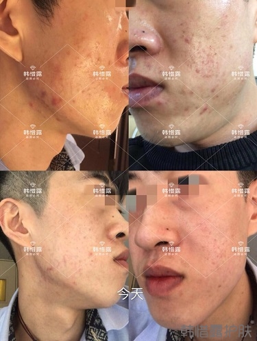敏感肌粉刺痘痘全部消下去了，痘坑也修復平整了一部分