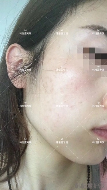 痘痘好了皮膚美麗，不想再記起曾經滿臉痘痘的自己！