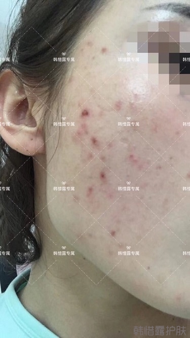 痘痘好了皮膚美麗，不想再記起曾經滿臉痘痘的自己！