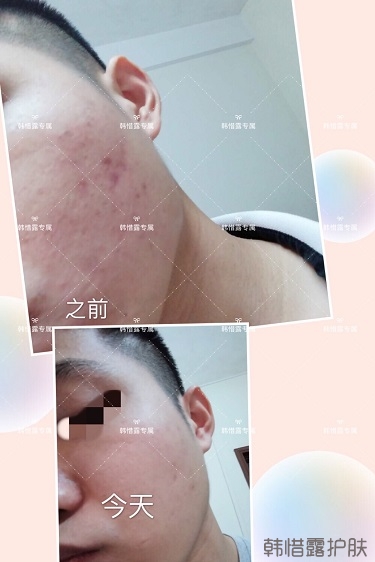 粉刺、痘痘、痘印、統(tǒng)統(tǒng)解決啦！祛痘去粉刺就是這么簡單！