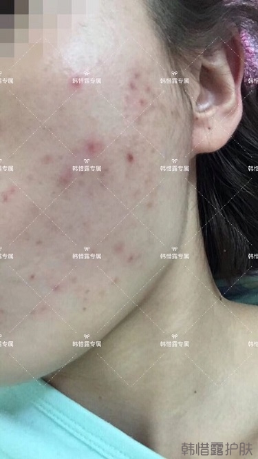 痘痘好了皮膚美麗，不想再記起曾經滿臉痘痘的自己！