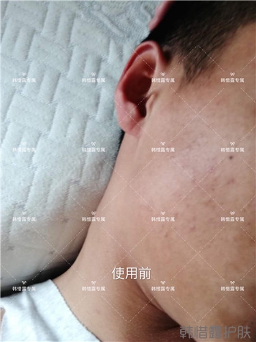 粉刺消了，皮膚光滑了，變帥氣不少呦！