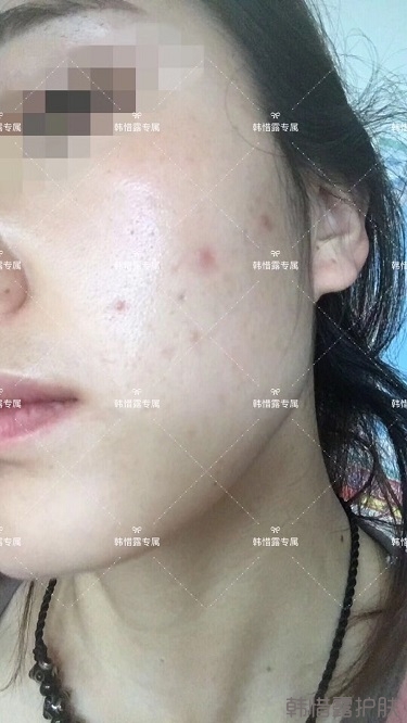 痘痘好了皮膚美麗，不想再記起曾經滿臉痘痘的自己！
