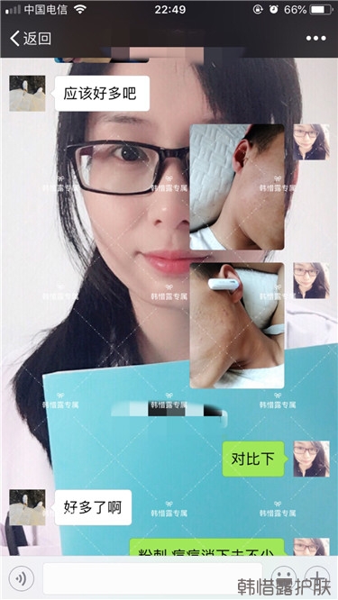 粉刺消了，皮膚光滑了，變帥氣不少呦！