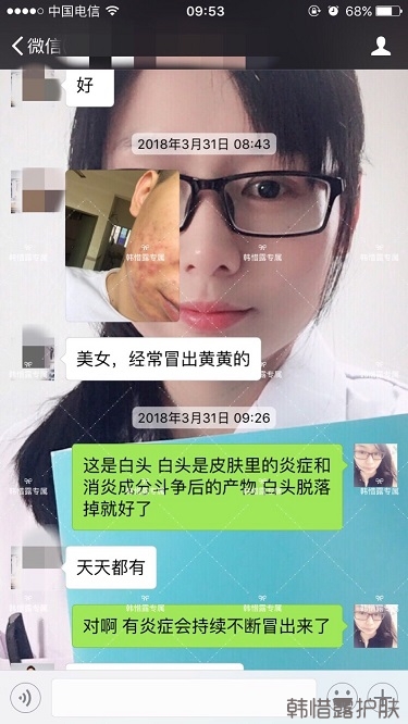 膿包結(jié)節(jié)發(fā)硬痘痘全消了，帥哥開心的來反饋了！
