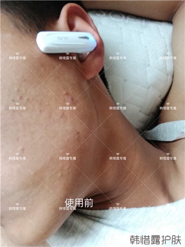 粉刺消了，皮膚光滑了，變帥氣不少呦！