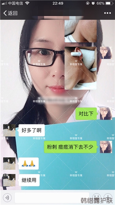 粉刺消了，皮膚光滑了，變帥氣不少呦！