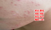 臉上長粉刺去粉刺的方法!不可錯過的去痘痘粉刺變美機會！