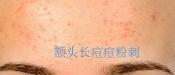 額頭長痘，臉頰長痘痘粉刺，就這樣恢復嫩白肌膚！