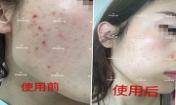 痘痘好了皮膚美麗，不想再記起曾經滿臉痘痘的自己！