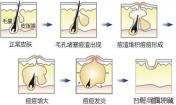 有去痘印最有效的方法嗎？