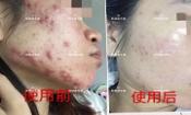 下巴長痘怎么辦？膿包痘祛痘效果，擁有干凈的臉不等待！