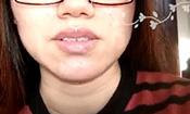 【祛痘視頻反饋】經期容易長痘，讓人很絕望，現在已經沒有痘痘了。